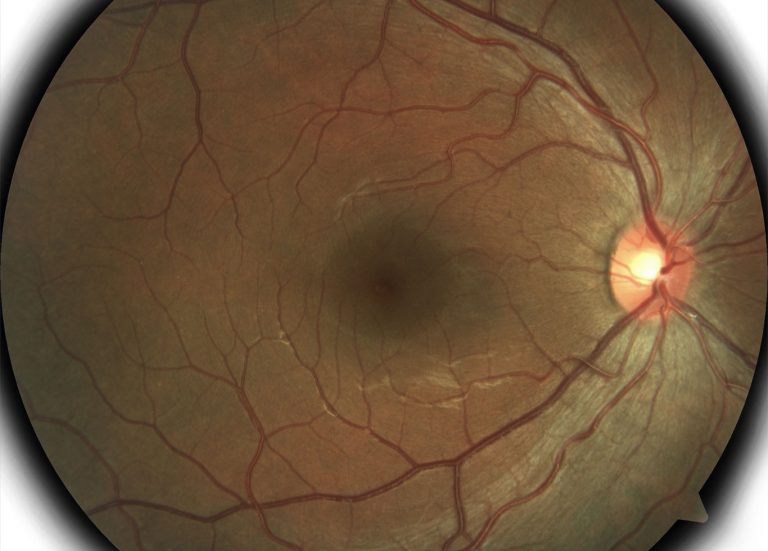 retinal photo